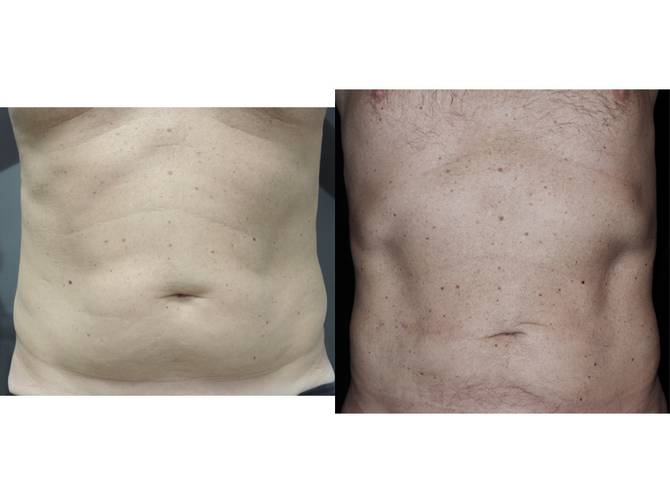 Liposcultura | Immagini pre/post 6