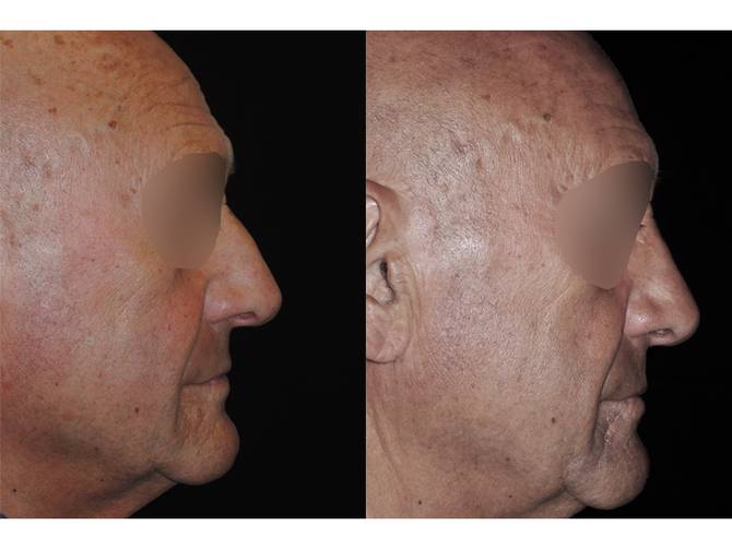 Rinoplastica | Immagini pre/post 16