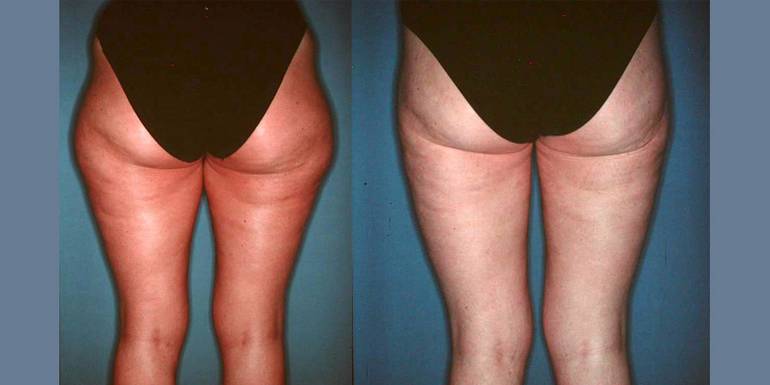 Liposcultura | Immagini pre/post 1