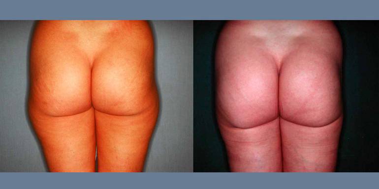 Liposcultura | Immagini pre/post 2