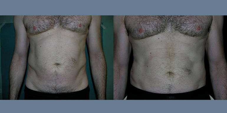 Liposcultura | Immagini pre/post 4