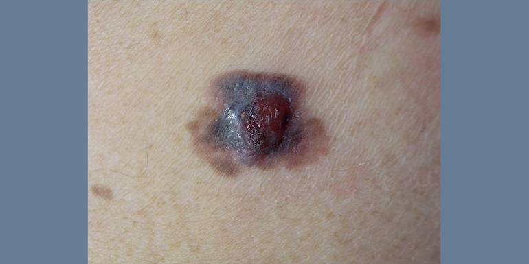 Nei e melanoma | Immagini 1