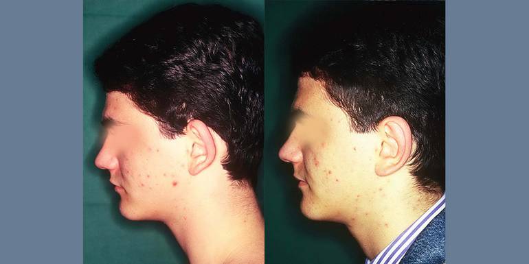 Otoplastica | Immagini pre/post 5